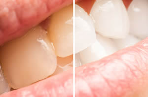 Dentist Claremont Cape Town Teeth Whitening